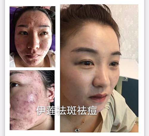 純中藥祛斑代理加盟招商